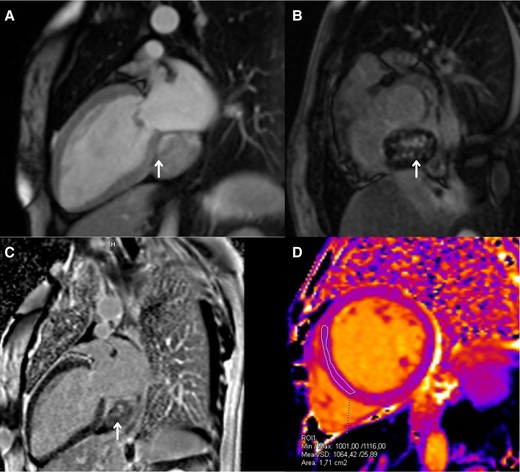 Cardiac magnetic resonance imaging. (A) Two-chamber long-axis view. T1 contrast enhanced with early post-gadolinium enhancement (arrow). (B) Short-axis view. T1 contrast enhanced, a late enhancement over the atrioventricular groove, with areas of intense enhancement in the central portion of the lesion (arrow). (C) Two-chamber long-axis view. T1 contrast enhanced, a late enhancement over the atrioventricular groove, with areas of intense enhancement in the central portion of the lesion (arrow). (D) Native (simple) T1 map in the mid-ventricular short-axis view, showing mild alterations.