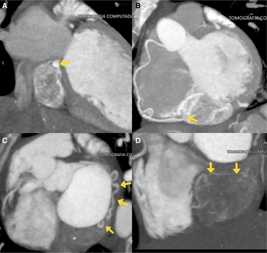Axial computed tomography of the heart. (A) Two-chamber long-axis view in venous phase. The coronary sinus (arrow) is compressed cephalically by the mass located in the atrioventricular groove, below the inferior wall of the left atrium. Progressive enhancement with intratumoural vessels indicative of its high vascularity. (B) Maximum intensity projection of the contrast. Intratumoural vascularization from the right coronary artery (arrow). (C and D) Maximum intensity projection of the contrast, where the main nutrient vessel originating from the circumflex artery is delineated (arrows), along with another vessel originating from the posterolateral branch of the right coronary artery. There is a prominent arterial vessel located within the lesion (D, arrows).