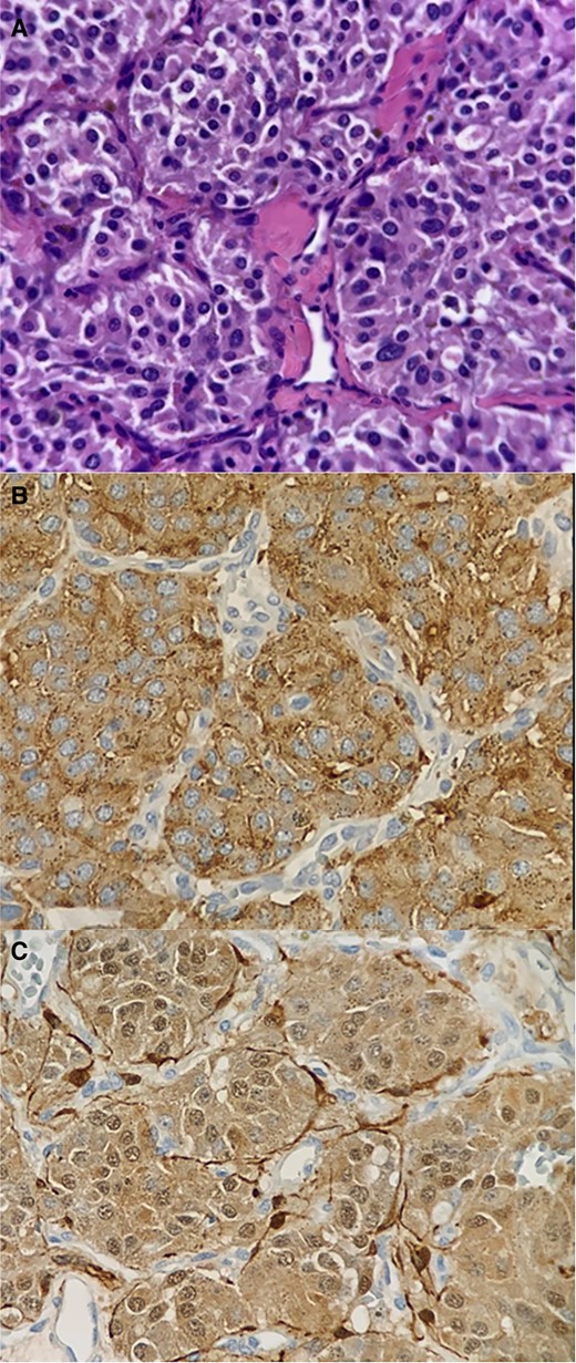 Histology (A) and immunohistochemistry (B and C). (A) Neoplastic lesion composed of intermediate-sized oval or ovoid cells with nuclei showing fine granular chromatin, exhibiting mild cytological atypia, and possessing pink cytoplasm. These cells form an ‘organoid’ pattern within thin fibrous septa (zellballen pattern). Dilated small blood vessels are observed. No areas of necrosis are present. (B and C) The neoplastic cells show positivity for CD56, synaptophysin, chromogranin, and S-100, while being negative for CKAE1-AE3, PAX-8, and PAGF. The vascular marker CD31 highlights the presence of small capillary vessels. The proliferation index KI-67 is <2%. The histological and immunophenotypic profile is consistent with a non-malignant neuroendocrine neoplasia, resembling a paraganglioma.