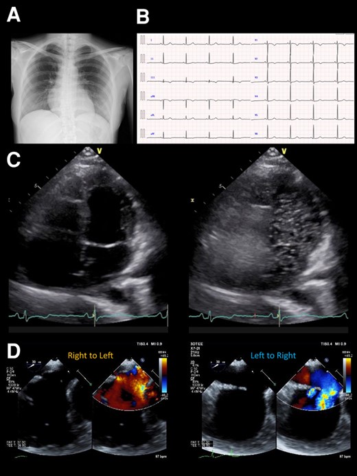 (A) Chest X-ray photograph showing a slightly enlarged cardio-thoracic ratio of 56%. (B). Electrocardiogram on admission showing a normal sinus rhythm of 53 b.p.m. without any bundle branch blocks. (C) Transthoracic echocardiography at rest showing a Grade 4 right-to-left shunt at the atrial level. (D) Colour Doppler flow imaging of transoesophageal echocardiography showing a bidirectional shunt through the atrial septal defect.