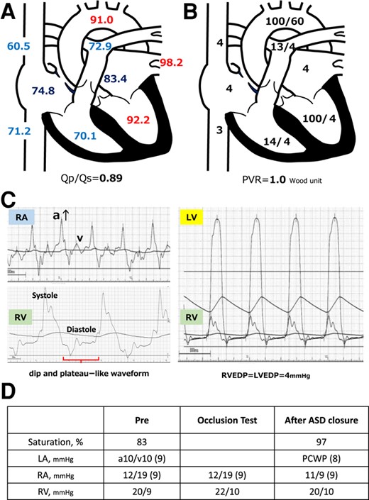 (A) Presenting oxygen saturation (%) under 3 L/min of oxygen administered by mask. Oxygen saturation increased in the right atrium and decreased from the pulmonary vein to the left atrium. (B) Pressure (mmHg) in each lumen of the right heart catheter is shown immediately after hospitalization. Each atrium and vein presents the mean pressure, whereas the ventricles, aorta, and pulmonary artery show systolic/diastolic pressure data. PVR, pulmonary vascular resistance. (C) The pressure waveforms by right heart catheterization showed a significant increase of ‘A’-wave in the right atrial pressure wave and dip-and-plateau pattern in the right ventricle. RA. right atrium; RV, right ventricle; LV, left ventricle; EDP, end-diastolic pressure. (D) Right heart catheter at ASD closure after volume loading with 500 mL normal saline shows oxygen saturation increases without any increase in central venous pressure or right atrial or ventricular pressure. PCWP, pulmonary capillary wedge pressure; ASD, atrial septal defect.