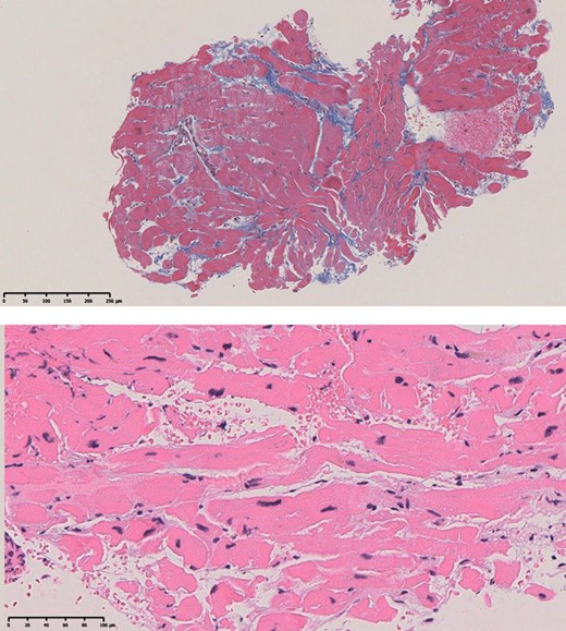 The upper panel is a weakly magnified Masson stain (×40) showing mild stromal fibrosis. The lower panel is a strongly magnified (×200) haematoxylin eosin-stained section showing a marked discrepancy in cardiomyocyte diameter.