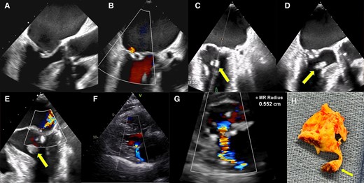 (A) Preprocedural transoesophageal echocardiography mid-oesophageal diastolic still frame view (120°) showing rheumatic mitral stenosis. (B) Preprocedural transoesophageal echocardiography systolic still frame (100°) showing trace of mitral regurgitation. (C) Per-procedural transoesophageal echocardiography (45°): after the second balloon inflation, a rounded echogenic mass is seen during systole in the left ventricular outflow tract (arrow). (D) Per-procedural transoesophageal echocardiography (135°): same echogenic mass. (E) Per-procedural transoesophageal echocardiography (0°): colour flow Doppler showing an eccentric jet consistent with moderate mitral regurgitation. (F) Post-procedure transthoracic parasternal long-axis view showing moderate mitral regurgitation. (G) The proximal isovelocity surface area (PISA) radius is 0.55 cm, and the mitral effective regurgitant volume and surface area are 21 mL and 10 mm2, respectively. (H) Surgical specimen showing valve remnants connected by a chorda to ruptured papillary muscle with necrotic tissue at its base (arrow).
