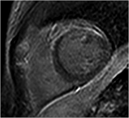 Initial cardiac magnetic resonance imaging demonstrating subepicardial delayed enhancement primarily affecting the anterior myocardium.