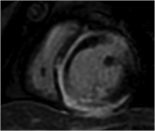 Serial cardiac magnetic resonance imaging demonstrating significant progression of disease with near circumferential subepicardial delayed enhancement of the left ventricular myocardium.