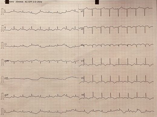 Electrocardiogram showing sinus tachycardia, anterior ST-segment elevation with Q-waves, and T-wave inversion with prolonged QT interval.