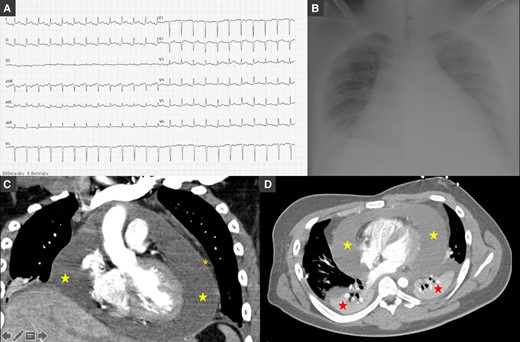 (A) Electrocardiogram showing sinus rhythm, normal PQ interval, QRS with normal duration, elevation of the ST-segment in leads V3–V6, aVL, LI, and LII, and ST-segment depression in aVR. (B) Chest radiography showing severe cardiomegaly, bilateral pleural effusion with large right-sided pleural effusion, parabronchial cuffing, and perihilar haziness. (C and D) Thorax computed tomography confirmed a circumferential pericardial effusion (yellow star) with maximum dimension of 40 mm with a thick pericardium (orange star) and bilateral pleural effusion (red star; with chest tube inserted in the right fifth intercostal space) in coronal (C) and axial (soft tissue) views (D).