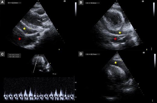 Echocardiography in parasternal long-axis (A), parasternal short-axis (B), and apical four-chamber (C and D) views showing pericardial effusion with large dimensions (30–33 mm, yellow star) with collapse of the right cavities and significant tricuspid inflow variation (46%) and pleural effusion (red star).