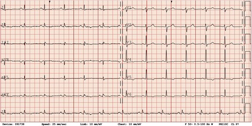 Electrocardiogram. Initial electrocardiogram showing normal sinus rhythm with T-wave inversions in leads V4–V6, DII, DIII, and aVF.