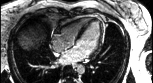 Cardiac magnetic resonance images. Cardiac magnetic resonance showing mid myocardium and subepicardial late gadolinium enhancement predominantly in the anterior and lateral walls.