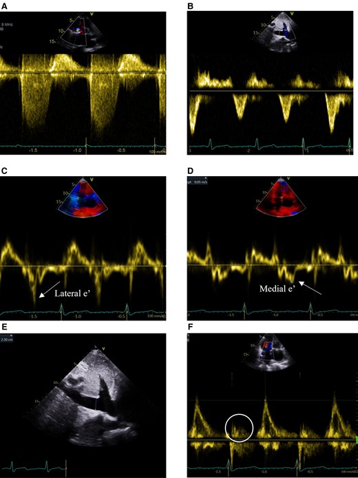 TTE continuous-wave Doppler (CWD) and pulsed-wave Doppler (PWD) evaluating TR and evidence of constrictive (CP) or restrictive (RCM) physiology. (A) CWD of TR signal without ‘dagger’-shaped appearance of severe TR. (B) Hepatic vein PWD without systolic flow reversal seen in severe TR, inspiratory diastolic flow reversals in RCM, or expiratory diastolic flow reversals in CP (respirometer not shown). (C) PWD of lateral mitral annulus (lateral > medial e’ inconsistent with annulus reversus seen in CP). (D) PWD of medial mitral annulus (medial e’=0.05 m/s not elevated inconsistent with annulus paradoxus seen in CP). (E) 2D measurement of dilated inferior vena cava (2.3 cm without inspiratory collapse). (F) Mitral inflow PWD large E without a significant A wave (circle) despite sinus rhythm.