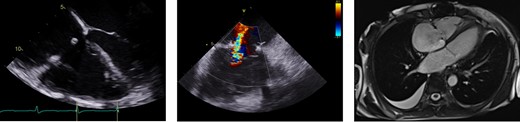 Multimodality imaging. TEE showing RA enlargement with well-seated annuloplasty ring (left). ICE revealing no more than moderate TR (middle). Cardiac MRI demonstrating significantly enlarged RA (right).
