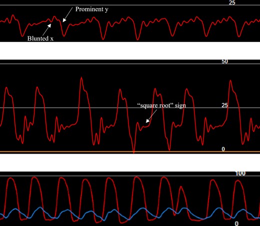 Invasive hemodynamics. RA tracing showing blunted x and prominent y descents without large v-waves suggestive of restrictive physiology (top). RV ‘square-root’ sign consistent with elevated end-diastolic pressure (middle). Simultaneous LV (red) and RV (blue) tracings without ventricular interdependence seen in constrictive physiology (bottom).