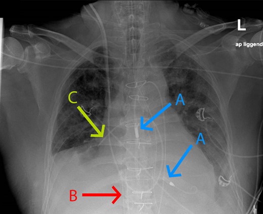 Chest X-ray of the patient with acute respiratory distress syndrome right before the prone position. Arrow A = Impella; Arrow B = extracorporeal membrane oxygenation cannula in the inferior vena cava; Arrow C = Schwan Ganz catheter in the right pulmonary artery.
