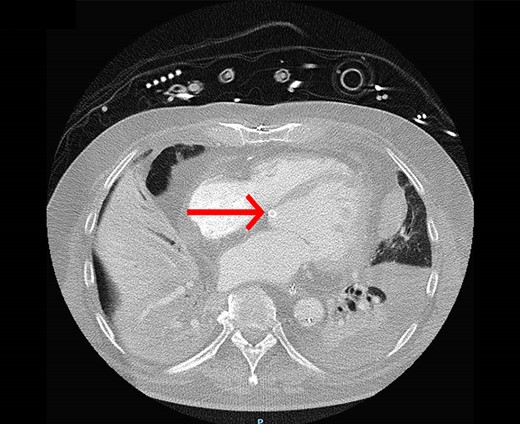 The computed tomography (CT) scan shows ground-glass opacification in the right lung, pleural effusion, and atelectasis of the left lower lung. The red arrow indicates the position of the Impella in the left ventricle.