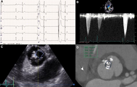 (A) Electrocardiography showing a Mobitz type II atrioventricular block and alternating bundle branch block. (B) Transthoracic echocardiography showing a maximum aortic valve flow velocity of 5.0 m/s at long RR intervals. (C) Three-dimensional transoesophageal echocardiography showing a bicuspid aortic valve with an area of 0.86 cm2. (D) Electrocardiography-gated CT at mid-systole showing a bicuspid aortic valve with area of 0.53 cm2. CT, computed tomography.