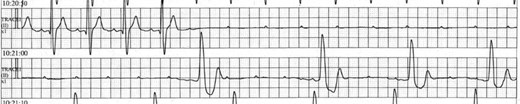 Electrocardiography showing a paroxysmal atrioventricular block with pre-syncope.