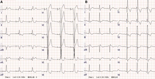 Electrocardiography acquired before (A) and after (B) surgery.