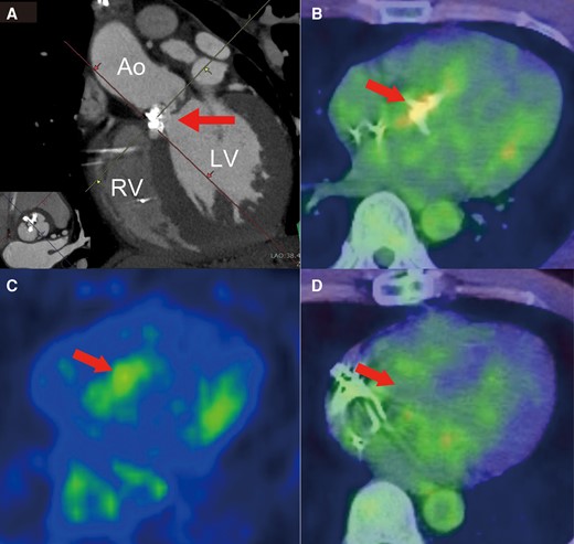 (A) Electrocardiography-gated computed tomography (CT) image revealing calcification reaching the muscular septum (arrow). (B) FDG-PET image showing accumulation of FDG in the aortic valve and calcified lesions connected to the interventricular septum (arrow). (C) FDG-PET only images of panel B. The maximum standardized uptake value at the arrow is 3.53. (D) FDG-PET imaging after surgery showing an obvious reduction of FDG uptake in the aortic valve and basal interventricular septum (arrow). Ao, aorta; LCC, left coronary cusp; LV, left ventricle; NCC, non-coronary cusp; RCC, right coronary cusp; RV, right ventricle; FDG-PET, fluorodeoxyglucose-positron emission tomography.