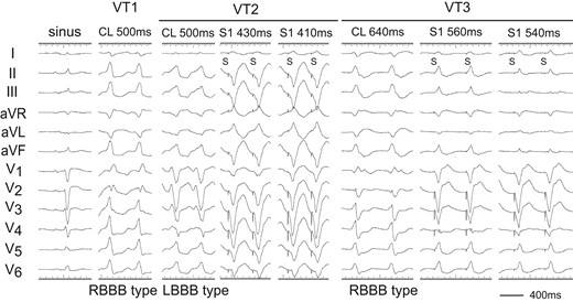 Twelve-lead ECGs of sinus rhythm and ventricular tachycardias (VTs: VT1, VT2, and VT3). After 1st RFCA, the VT1 changed to VT3. During the VT2 and VT3, pacing from the right ventricular apex (RVA) demonstrated constant and progressive fusion. S, stimulus.