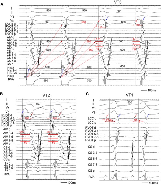 (A) Entrainment pacing during the VT3. The AIV catheter recorded a fragmented potential (Fg). During burst pacing from the RVA, the Fg and ventricular potential in the CS catheter activated orthodromically (red dotted arrow), while that in the His catheter was activated antidromically (blue dotted arrow). The distal electrode of the RVOT (RVOT d) recorded a far field potential (red arrow), which was also activated orthodromically (red dotted arrow). The conduction time between the far field (red arrow) and near field (blue arrow) potential was 110 ms. (B) During the VT2, the RVOT d recorded the far field potential (red arrow) and near field potential (blue arrow). The sequence of these potentials was reversed as compared to that during the VT3, and the conduction time between two potentials was 138 ms. (C) During the VT1, the distal electrode of left coronary cusp (LCC d) also recorded near field (blue arrow) and far field (red arrow) potentials. The conduction time between two potentials was 191 ms. Each dotted vertical line indicates onset of the QRS complex. Shown are the surface ECGs, leads I, II, V1, V5, and V6, and intracardiac electrograms recorded from the right ventricular outflow tract (RVOT), anterior intraventricular vein (AIV), coronary sinus (CS), His bundle (His), right ventricular apex (RVA), and left coronary cusp (LCC) catheter. Fg, fragmented potential; d, distal electrodes; p, proximal electrodes; S, stimulus.