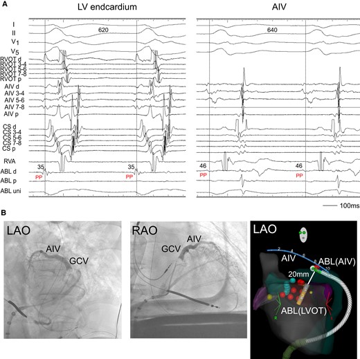 (A) Radiofrequency catheter ablation. During the VT2, the ABL, which was located below the LCC, recorded the pre-systolic potential (PP). The PP was also observed at the ABL placed in the AIV. ABL, ablation catheter; PP, pre-systolic potential. Other abbreviations are the same as in Figure 2. (B) Coronary venography showed AIV and great cardiac vein (GCV). (C) Two ablation catheters and an AIV catheter during the bipolar ablation are shown in the electroanatomic mapping image. Bipolar ablation was performed between the left ventricular endocardium (LVOT) and AIV. The distance between the tips of two catheters was 20 mm. ABL (LVOT), an ablation catheter in the left ventricular endocardium; ABL (AIV), an ablation catheter in the AIV.