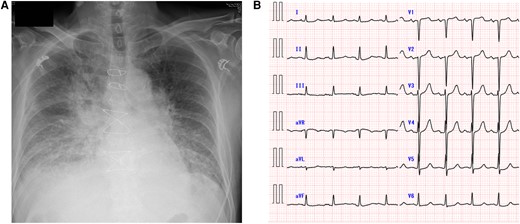 Chest X-ray and electrocardiogram. The patient’s chest radiograph revealed marked pulmonary congestion (A). Electrocardiography revealed a heart rate of 102 beats/min and ST depression in the lateral thoracic leads (B).