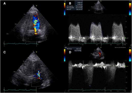 Transthoracic echocardiography in emergency room. Transthoracic echocardiography revealed massive turbulent colour Doppler signal (A), increased transmitral flow (B), mild to moderate tricuspid regurgitation (C), and increased estimated pulmonary artery systolic pressure (D).