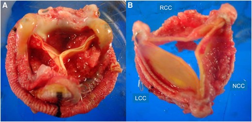 Surgical specimen. The excised mitral valve prosthesis has vegetations on all three leaflets (A). The excised aortic valve is covered with vegetations (B).