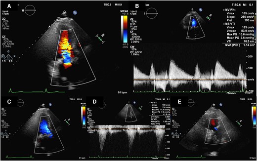 Post-operative transthoracic echocardiography. Transthoracic echocardiography revealed good prosthetic mitral valve function (A and B), prosthetic aortic valve function (C and D), and trivial TR (E).