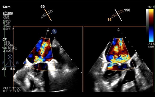The transoesophageal echocardiography revealed severe mitral regurgitation.