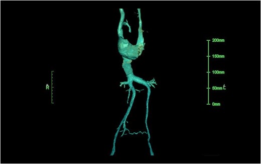 The contrasted computed tomography demonstrated the persisted left superior vena cava and the duplicated inferior vena cava. The diameter of her right inferior vena cava was 4.6 mm.