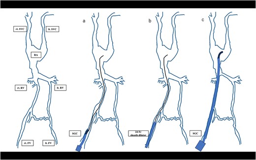 A schematic diagram of the bougie manoeuvre (rt. SVC, right superior vena cava. lt. SVC, left superior vena cava; RA, right atrium. rt. RV, right renal vein. lt. RV, left renal vein. rt. FV, right femoral vein. lt. FV, left femoral vein.).