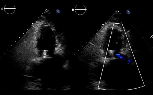 Post-operative transthoracic echocardiography revealed a significant reduction of mitral regurgitation.