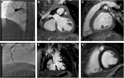 Angiography and CMR images. Angiography and CMR imaging—(A, B, D) chronic occlusion of the RCA with bridging collateral vessels (B, dotted arrow), (C) mural thrombi in LAD (star), (E, F) late-gadolinium enhancement without evidence for myocardial infarction.