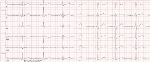 Electrocardiogram showing mild right ventricular conduction delay.