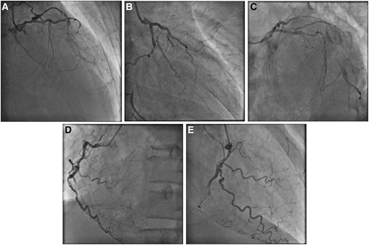 Diagnostic coronary angiography. (A) Right anterior oblique (RAO) cranial, (B) RAO caudal, and (C) left anterior oblique (LAO) caudal views of left coronary artery. (D) LAO and (E) RAO views of right coronary artery.