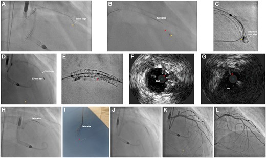 Bailout for entrapment and uncoiling of coronary guidewire. (A) Entrapment of coronary guidewire tip (arrowhead) during its removal. (B) Retrieval with Turnpike microcatheter (Teleflex, USA) led to unravelling (asterisk) of the distal segment of the guidewire from its tip (arrowhead). (C) ClearStent (Siemens Healthineers, Germany) showing the entrapped wire tip (arrowhead) with deformity of the distal stent edge. (D) Rotational atherectomy with 1.5 mm burr successfully crossed the deformed distal stent edge, with simultaneous transection and embolization of the radio-opaque wire tip (arrowhead) into a septal artery. (E) ClearStent showing residual wire filaments (asterisk) within the stent. (F) IVUS showing residual wire filaments (asterisk) in LAD stent. (G) Wire filaments (asterisk) extending to aorta (Ao). (H) Removal of wire filaments with ‘Twist-wire’ technique. (I) Successful retrieval of wire filaments (asterisk). (J) Balloon optimization of deformed distal stent edge. (K) Satisfactory final angiographic result, embolized wire tip confirmed to be in small septal artery (arrowhead). (L) Follow-up angiography at 4 months showing patent stents.
