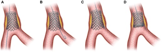 Schematic image depicting wire entrapment caused by ‘branch point malapposition’ (BPM). (A) Stent deployment just proximal to bifurcation along the wire in distal main vessel. (B) Wire switched to side branch with a loop tip. (C) Wire tip caught by distal stent edge during retrieval due to BPM. (D) Stent deformity caused by pulling of entrapped wire.