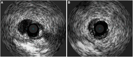 IVUS image demonstrating BPM. (A) Absence of stent coverage at carina. (B) Stent coverage at branch point with potentially malapposed struts (arrowheads).