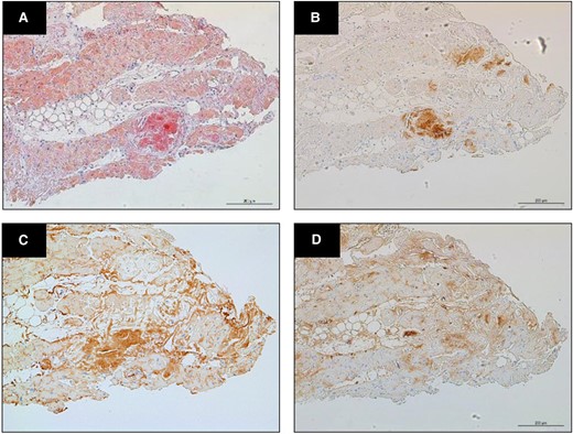(A) Myocardial biopsy showed amyloid deposits staining with Congo red (×40 magnification). (B) On immunohistochemistry, staining was positive for anti-transthyretin antiserum. (C) Lambda and (D) kappa staining was diffusely stained in areas different from amyloid deposition, therefore these staining was considered to be non-specific.