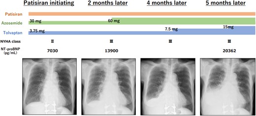 Patisiran (0.3 mg per kg of body weight intravenously once every 3 weeks) was initiated for ATTRv. Although her clinical course was atypical for ATTRv, including increased diuretics, increased congestion, and pleural effusion on chest radiography.