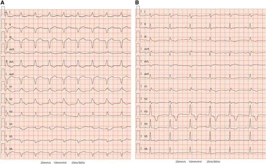 Electrocardiogram. (A) Initial ECG on arrival to emergency department showing sinus tachycardia with 1st degree atrioventricular (AV) block, complete right bundle branch block (RBBB), and left anterior fascicular block (LAFB). (B) The ECG performed on discharge showed resolution of 1st degree AV block and LAFB and the occurrence of left posterior fascicular block (LPFB) and partial improvement of RBBB.