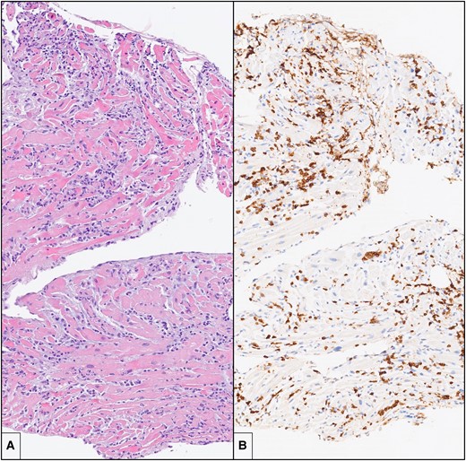 Endomyocardial biopsy. (A) There is an intense and diffuse mononuclear interstitial inflammatory infiltrate in association with damage and necrosis of cardiac myocytes (haematoxylin and eosin; original magnification: 10×). (B) Immunohistochemistry for CD3 shows that a large portion of the inflammatory infiltrate is composed by CD3+ T lymphocytes, with formation of clusters (immunohistochemistry, original magnification: 10×).