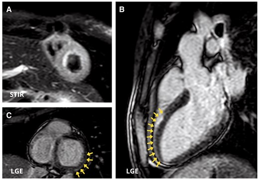 Cardiac magnetic resonance images. (A) Short-axis view showing diffuse oedema in the left ventricular wall in T2 Short Time inversion recovery (STIR) sequences. (B and C) Three-chamber view (B) and short-axis view (B) demonstrate myocardial late gadolinium enhancement with sub-epicardial distribution in the mid-apical segment of antero-septal wall and in the basal segment of inferior and infero-lateral walls (arrows).