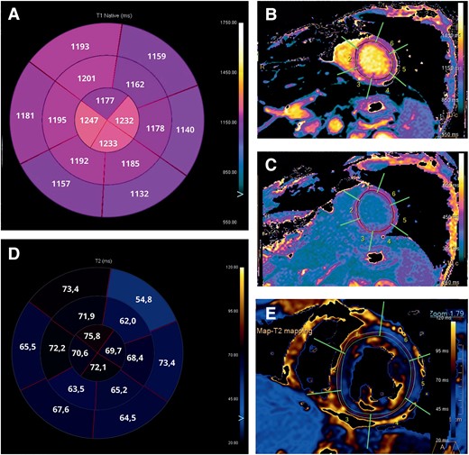 Cardiac magnetic resonance images. (A) Bullseye plot showing the native T1 times. Segmentation was performed according to the AHA 16-segment model. (B and C) Native T1 times and T1-enhanced were increased in all segments, especially in mid and apical segments. (D) Bullseye plot showing the native T2 times. (E) Native T2 times were increased in all segments, especially in mid and apical segments.