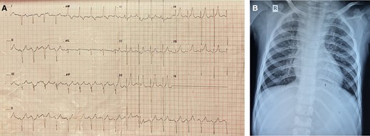 (A) Electrocardiogram of the patient. (B) Chest X-ray of the patient showing plethoric lung fields.