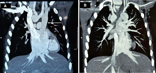 Cardiac CT of the patient showing (A) LSVC draining into the left side of the common atrium (arrow) and (B) pulmonary veins draining into the LSVC (star).