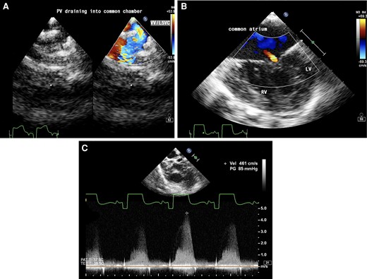 Transoesophageal echocardiogram (A) upper oesophageal view with colour Doppler showing pulmonary veins draining into vertical vein (VV)/left superior vena cava (LSVC). (B) Mid-oesophageal four-chamber view showing a common atrium, hypoplastic left ventricle (LV), well-formed right ventricle (RV), and mild common atrioventricular valve regurgitation. (C) Aortic short axis view with continuous wave Doppler across pulmonary valve showing pulmonary stenosis with a gradient of 85 mmHg.