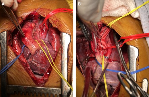 (A) Intraoperative photograph showing LSVC (red sling) with pulmonary veins draining into it, small MPA (yellow sling). (B) LSVC has been transected just below the junction of LSCV and LIJV and left-sided BD Glenn was done using an 8 mm Dacron tube graft. Pulmonary veins draining via LSVC/vertical vein into the common atrium (red sling).